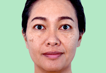 Melasma or Hyperpigmentation img