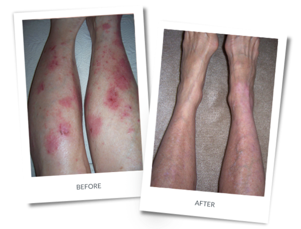 Severe Dermatitis