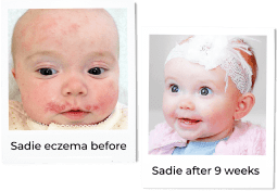 Teledermatology by Cheryl Lee MD Rx Sensitive Skin Care with before and after photo of a baby with eczema.